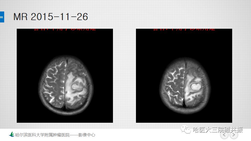 影像PPT - 【PPT】脑内环形强化 除了转移瘤你能想到什么-24