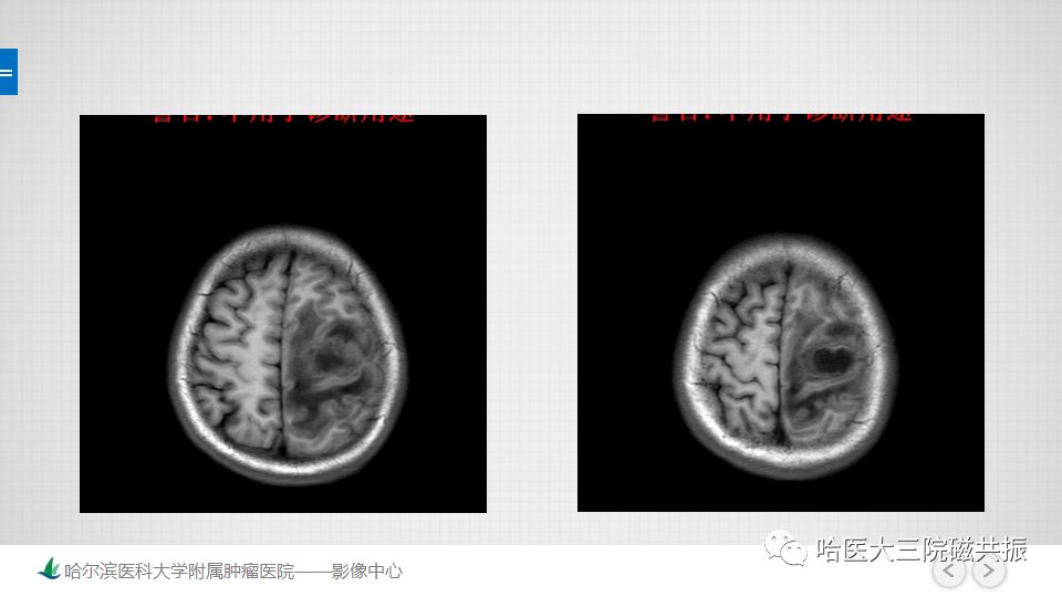 影像PPT - 【PPT】脑内环形强化 除了转移瘤你能想到什么-25