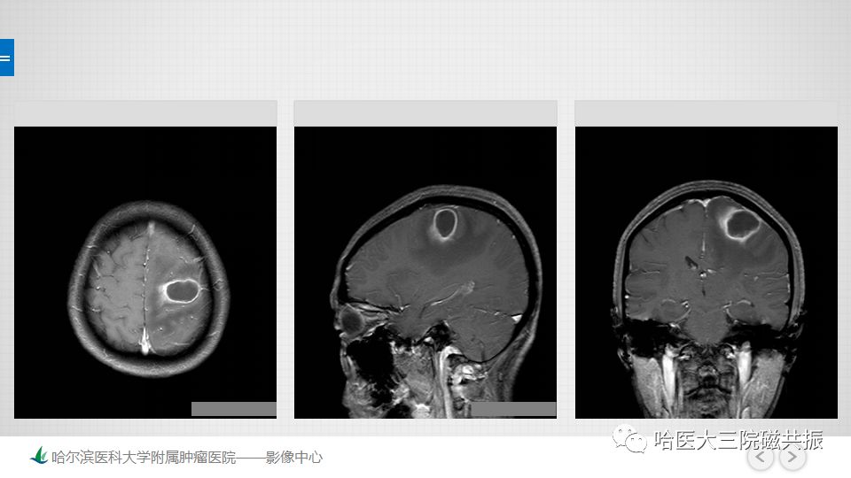 影像PPT - 【PPT】脑内环形强化 除了转移瘤你能想到什么-26