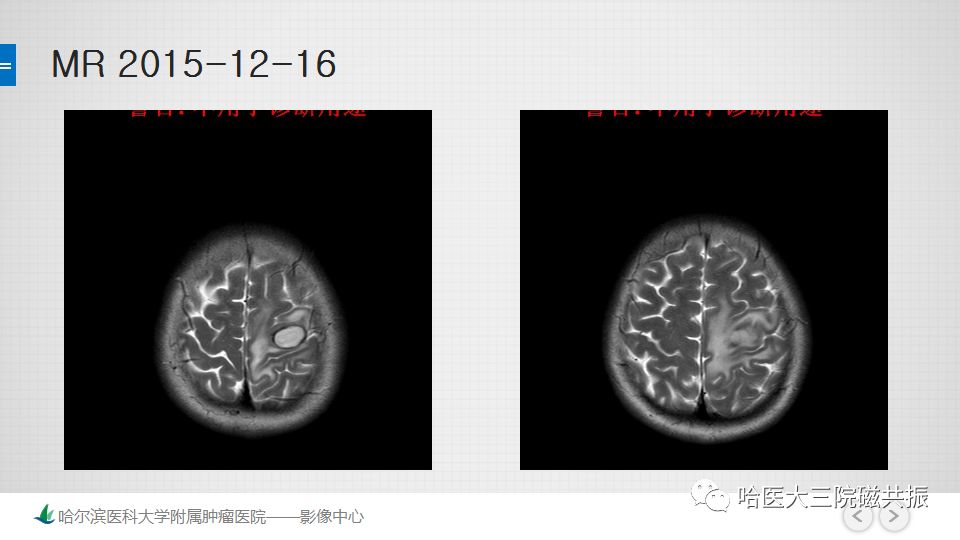 影像PPT - 【PPT】脑内环形强化 除了转移瘤你能想到什么-28