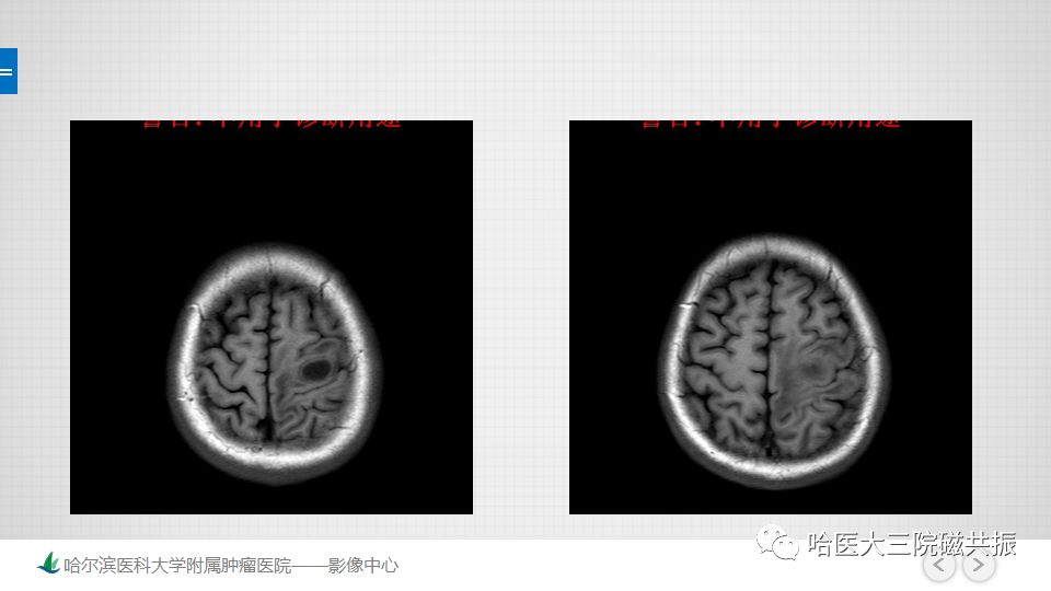 影像PPT - 【PPT】脑内环形强化 除了转移瘤你能想到什么-29