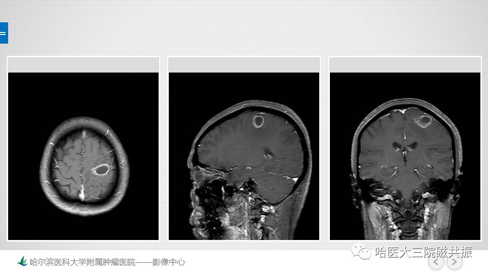 影像PPT - 【PPT】脑内环形强化 除了转移瘤你能想到什么-30