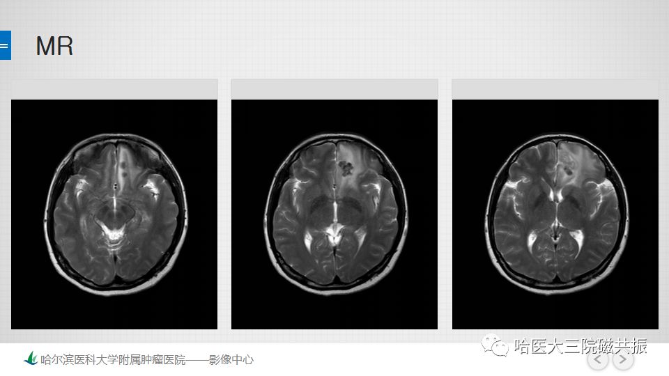 影像PPT - 【PPT】脑内环形强化 除了转移瘤你能想到什么-34