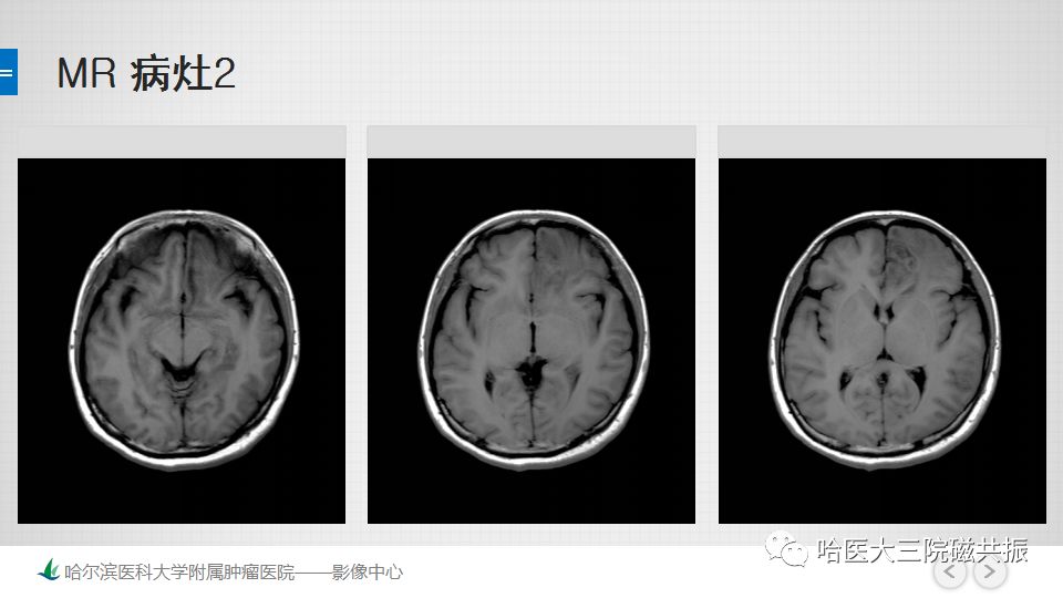 影像PPT - 【PPT】脑内环形强化 除了转移瘤你能想到什么-35