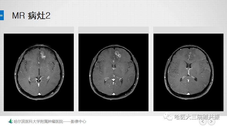 影像PPT - 【PPT】脑内环形强化 除了转移瘤你能想到什么-36