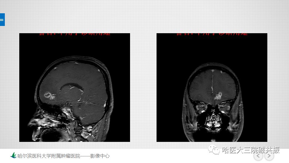 影像PPT - 【PPT】脑内环形强化 除了转移瘤你能想到什么-37