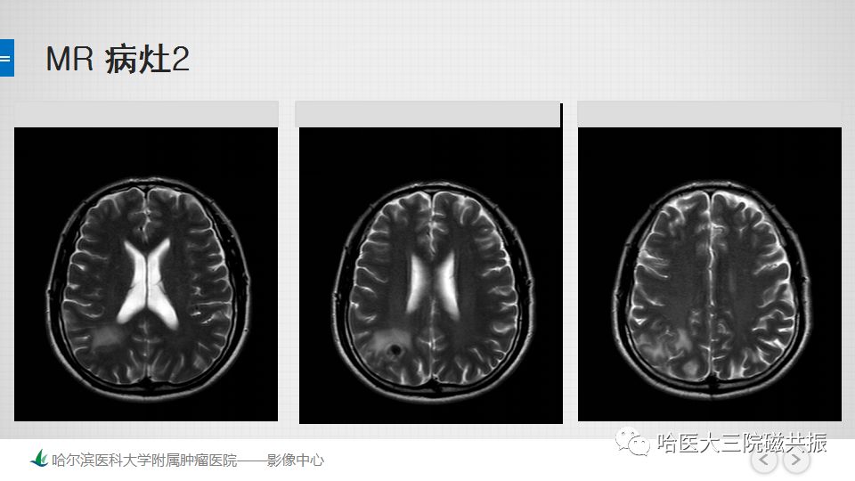 影像PPT - 【PPT】脑内环形强化 除了转移瘤你能想到什么-40