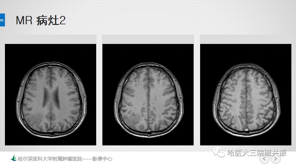 影像PPT - 【PPT】脑内环形强化 除了转移瘤你能想到什么-41