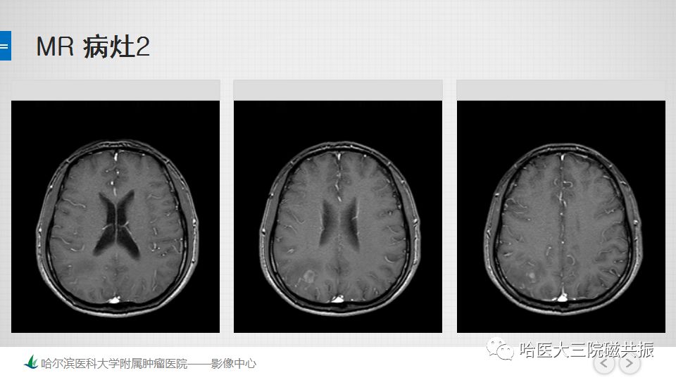 影像PPT - 【PPT】脑内环形强化 除了转移瘤你能想到什么-42
