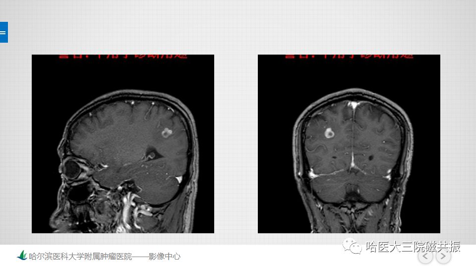 影像PPT - 【PPT】脑内环形强化 除了转移瘤你能想到什么-43