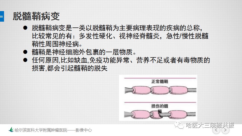影像PPT - 【PPT】脑内环形强化 除了转移瘤你能想到什么-44