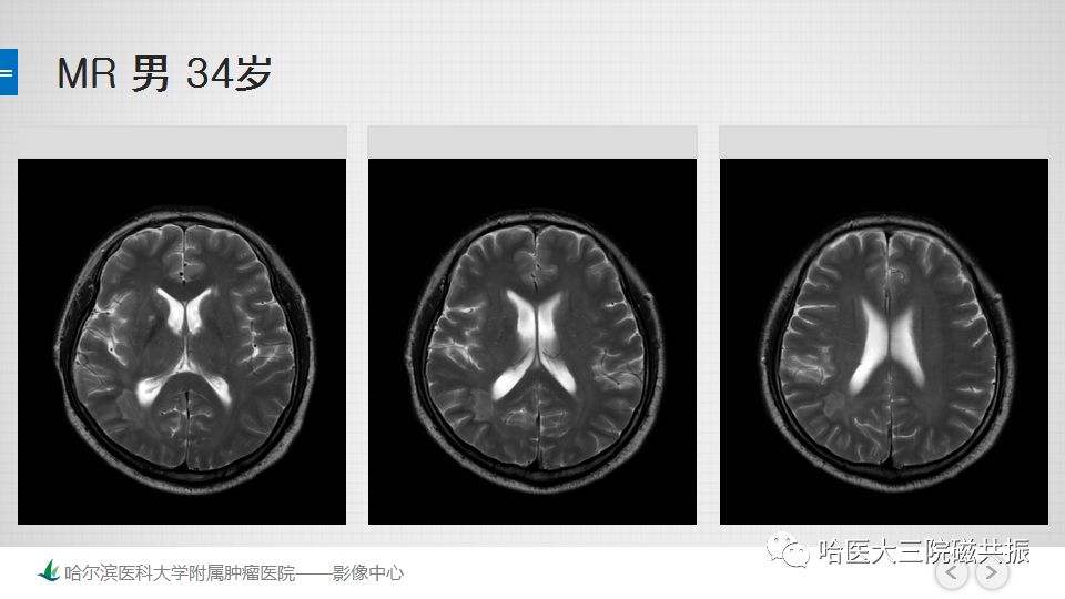 影像PPT - 【PPT】脑内环形强化 除了转移瘤你能想到什么-45