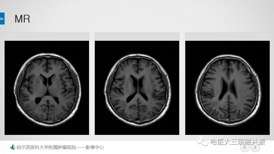 影像PPT - 【PPT】脑内环形强化 除了转移瘤你能想到什么-46
