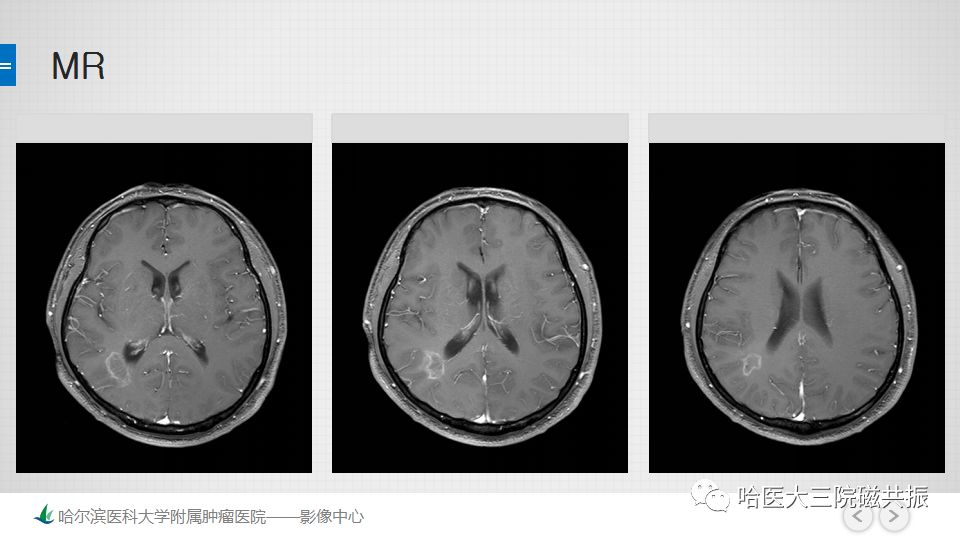影像PPT - 【PPT】脑内环形强化 除了转移瘤你能想到什么-47