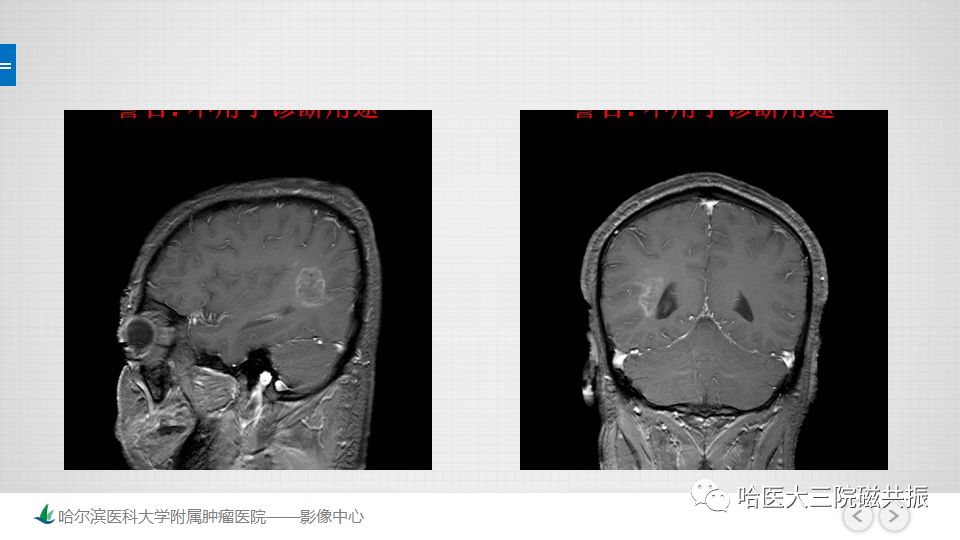 影像PPT - 【PPT】脑内环形强化 除了转移瘤你能想到什么-48