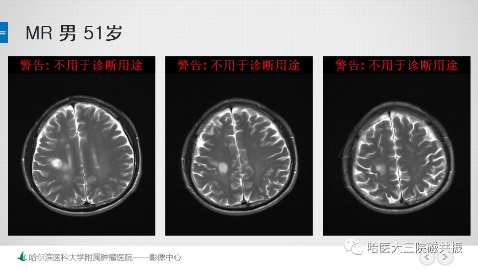 影像PPT - 【PPT】脑内环形强化 除了转移瘤你能想到什么-49
