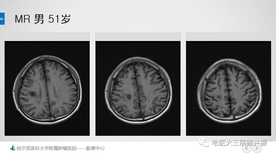 影像PPT - 【PPT】脑内环形强化 除了转移瘤你能想到什么-50