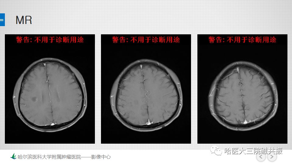 影像PPT - 【PPT】脑内环形强化 除了转移瘤你能想到什么-51