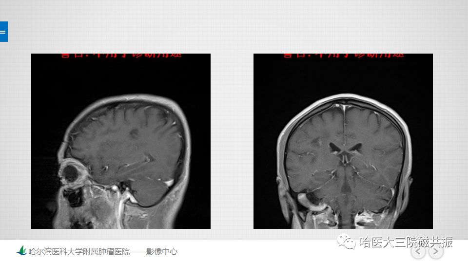 影像PPT - 【PPT】脑内环形强化 除了转移瘤你能想到什么-52