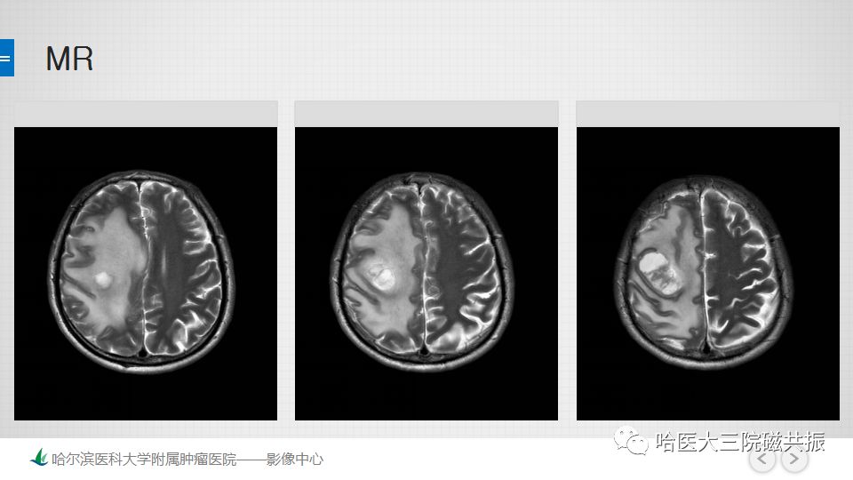 影像PPT - 【PPT】脑内环形强化 除了转移瘤你能想到什么-54