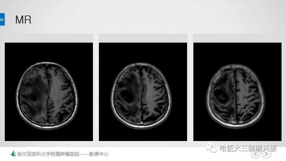 影像PPT - 【PPT】脑内环形强化 除了转移瘤你能想到什么-55