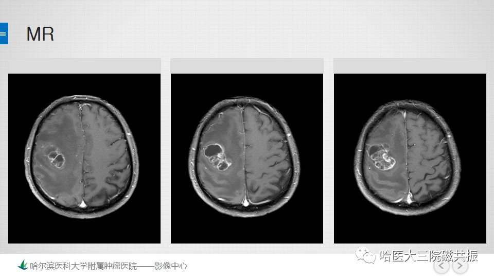 影像PPT - 【PPT】脑内环形强化 除了转移瘤你能想到什么-56