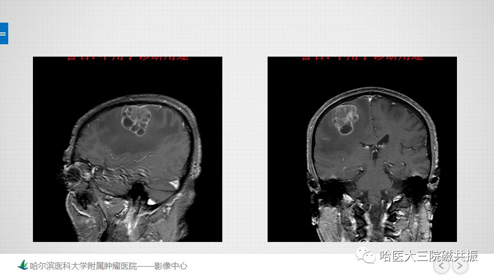 影像PPT - 【PPT】脑内环形强化 除了转移瘤你能想到什么-57