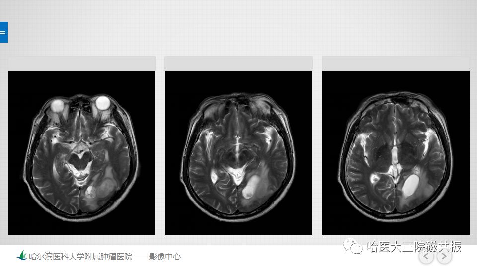 影像PPT - 【PPT】脑内环形强化 除了转移瘤你能想到什么-60