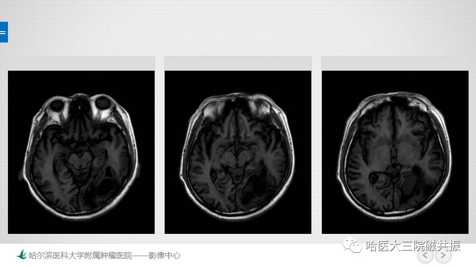 影像PPT - 【PPT】脑内环形强化 除了转移瘤你能想到什么-61