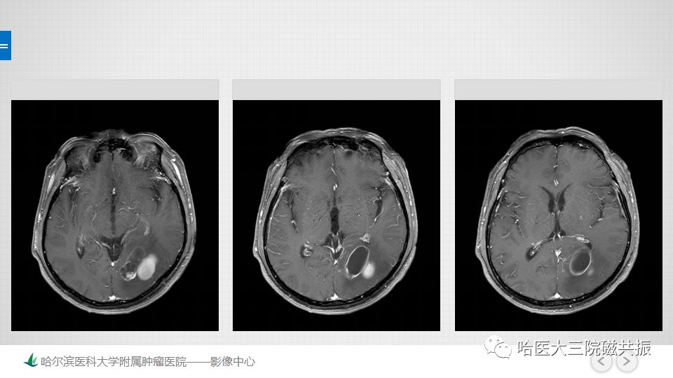 影像PPT - 【PPT】脑内环形强化 除了转移瘤你能想到什么-62