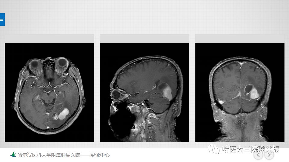 影像PPT - 【PPT】脑内环形强化 除了转移瘤你能想到什么-63