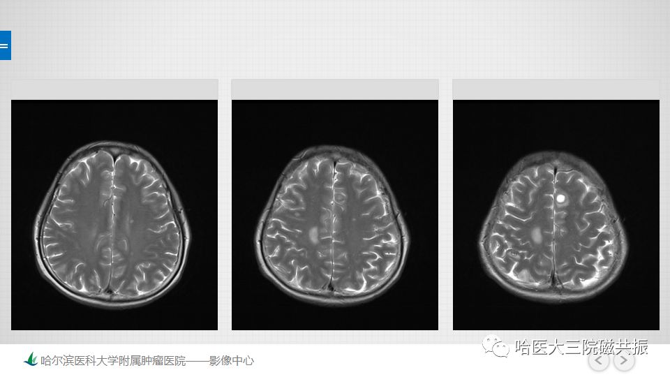 影像PPT - 【PPT】脑内环形强化 除了转移瘤你能想到什么-65