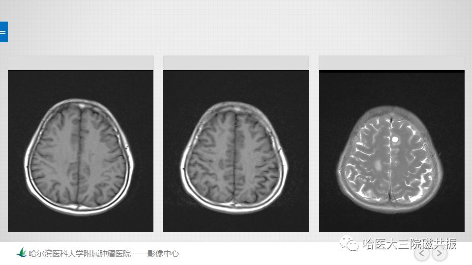 影像PPT - 【PPT】脑内环形强化 除了转移瘤你能想到什么-66