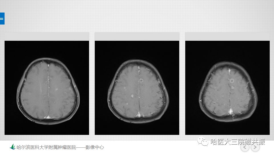 影像PPT - 【PPT】脑内环形强化 除了转移瘤你能想到什么-67