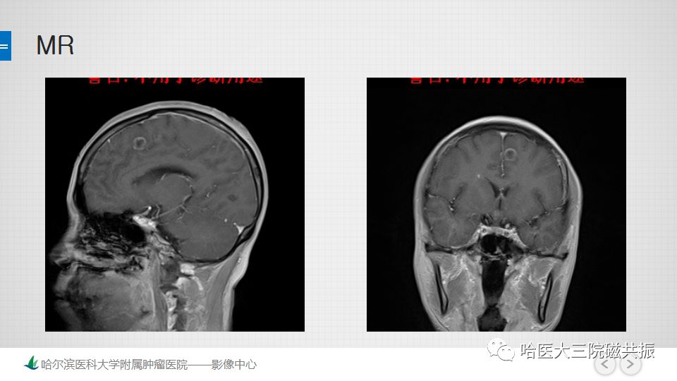 影像PPT - 【PPT】脑内环形强化 除了转移瘤你能想到什么-68