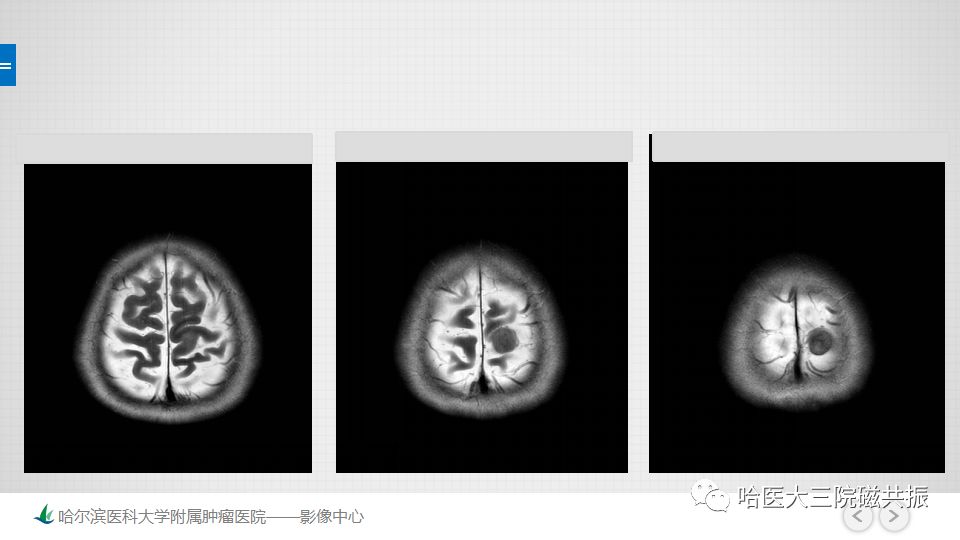 影像PPT - 【PPT】脑内环形强化 除了转移瘤你能想到什么-70