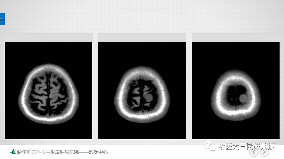 影像PPT - 【PPT】脑内环形强化 除了转移瘤你能想到什么-71