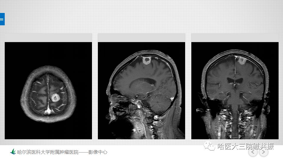 影像PPT - 【PPT】脑内环形强化 除了转移瘤你能想到什么-72