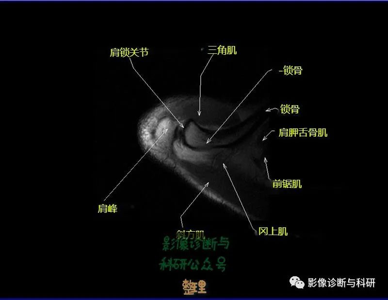 影像PPT - 肩关节MR轴位详细标注-2