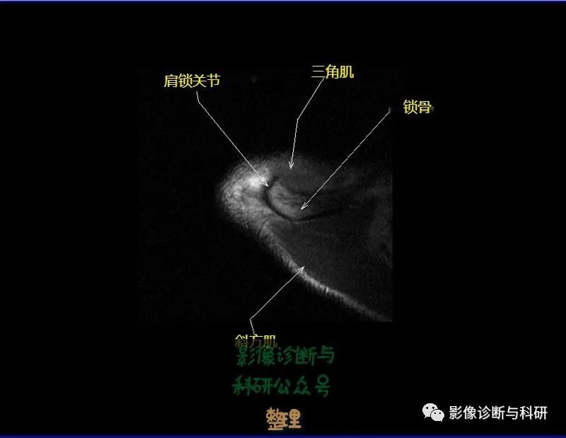 影像PPT - 肩关节MR轴位详细标注-1