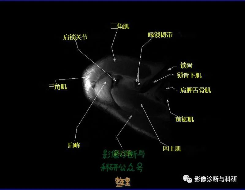 影像PPT - 肩关节MR轴位详细标注-3