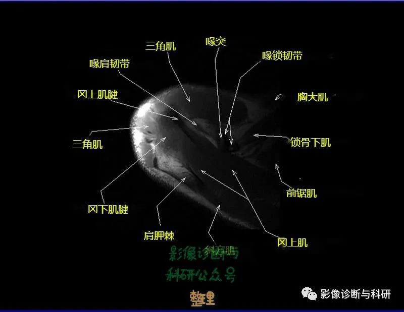 影像PPT - 肩关节MR轴位详细标注-4