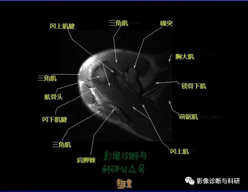 影像PPT - 肩关节MR轴位详细标注-5