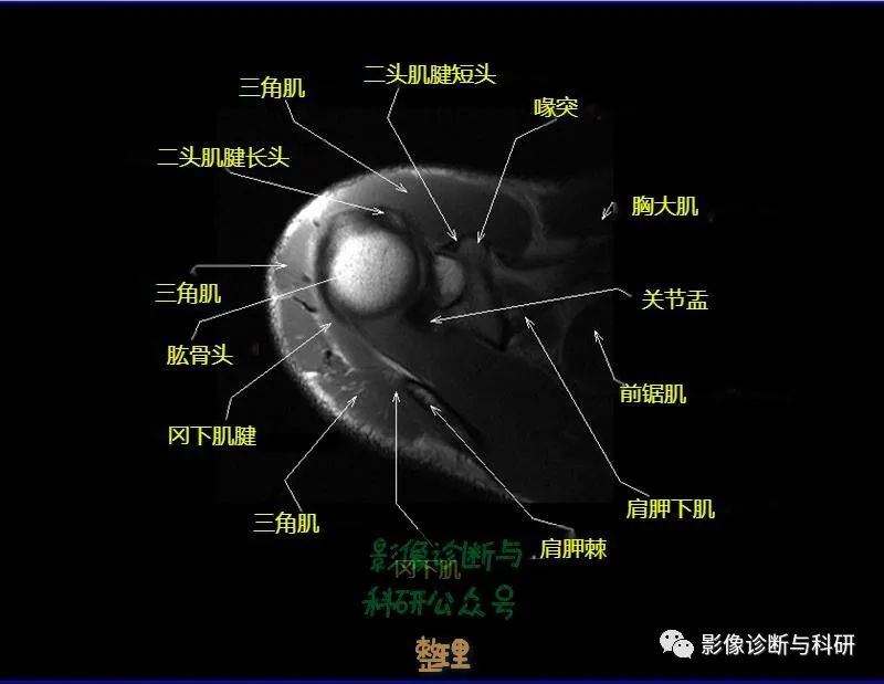 影像PPT - 肩关节MR轴位详细标注-6