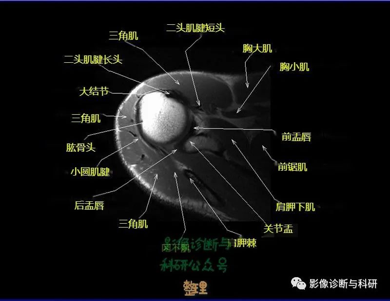 影像PPT - 肩关节MR轴位详细标注-7