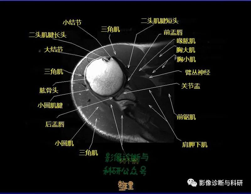 影像PPT - 肩关节MR轴位详细标注-9