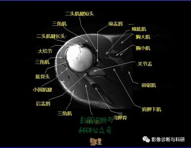 影像PPT - 肩关节MR轴位详细标注-8