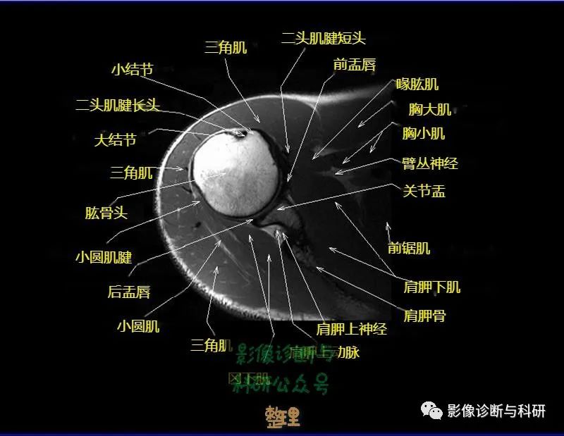 影像PPT - 肩关节MR轴位详细标注-10