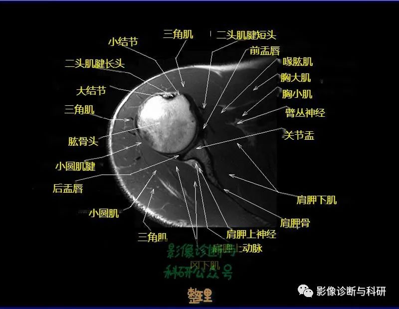 影像PPT - 肩关节MR轴位详细标注-11