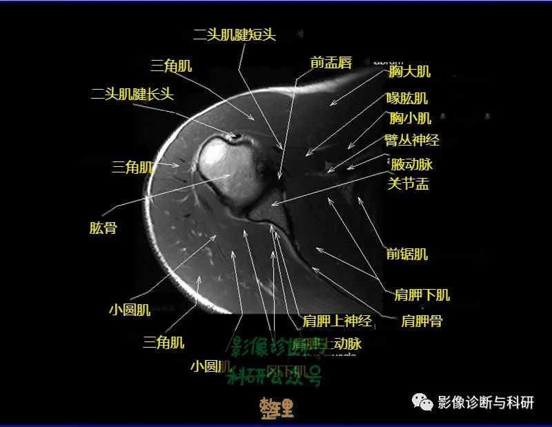 影像PPT - 肩关节MR轴位详细标注-13